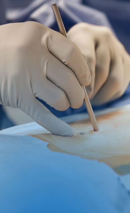 Minimally Invasive Lumbar Laminectomy