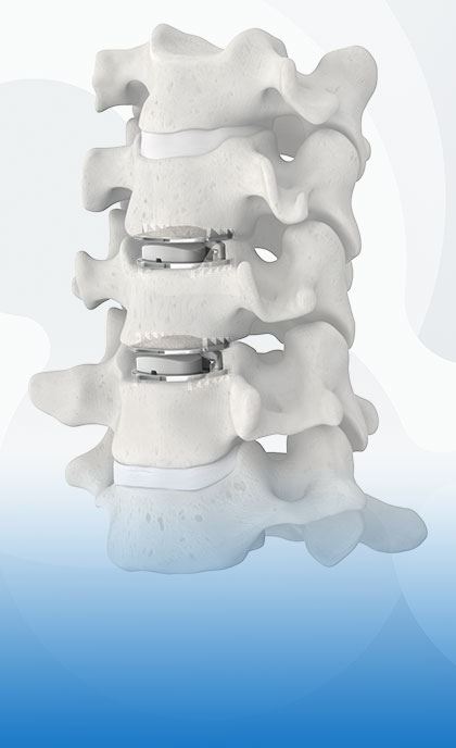 Artificial Disc Replacement 